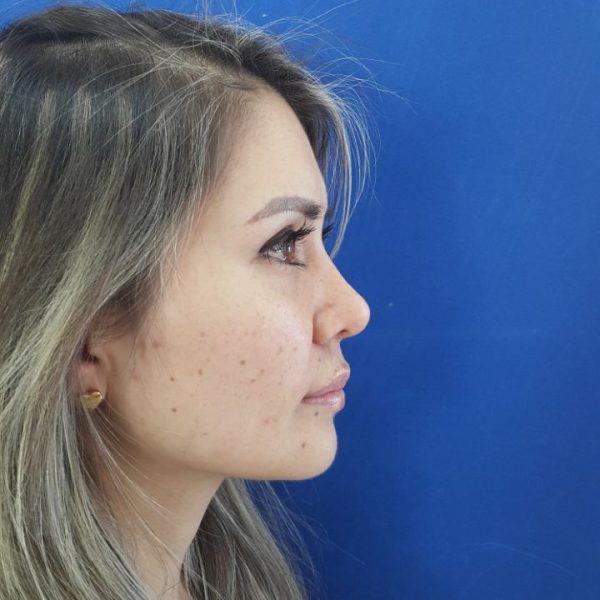 Rinoplastia Quito Dr Efrain Lopez Otorrinolaringologo Caso 9 AD Rinoplastia Quito Dr Efrain Lopez Otorrinolaringologo Caso 9 AD