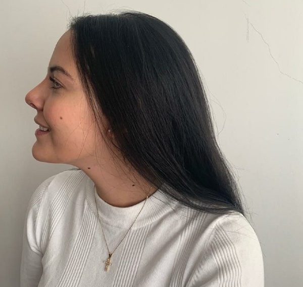 Cirugía rinoplastia punta nasal dr efrain lopez