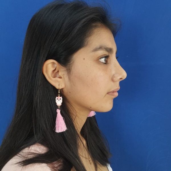 Cirugía rinoplastia punta nasal dr efrain lopez