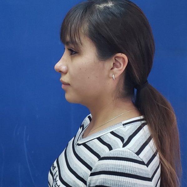 Rinoplastia Quito Dr Efrain Lopez Otorrinolaringologo Caso 3 Despues-min Rinoplastia Quito Dr Efrain Lopez Otorrinolaringologo Caso 5 Despues-min