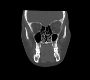 rinoplastia desviación desvio de tabique dr efrain lopez otorrinolaringólogo quito