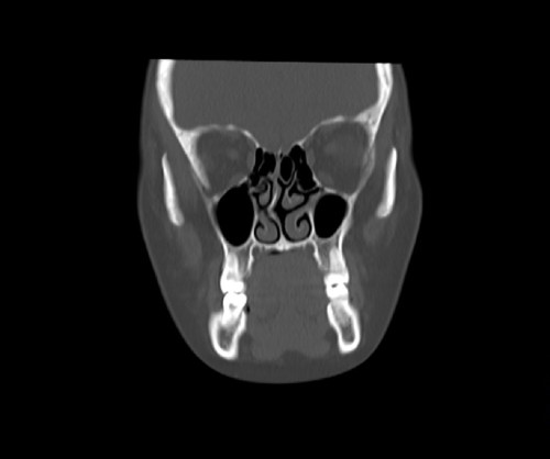 rinoplastia desviación desvio de tabique dr efrain lopez otorrinolaringólogo quito