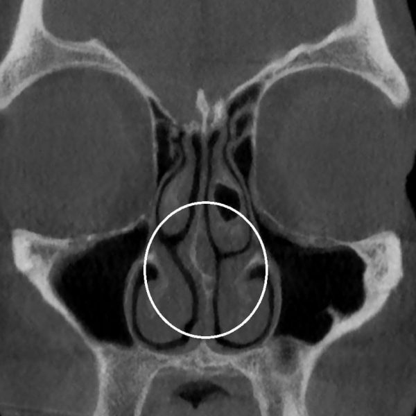 Cirugía de nariz Dr. Efraín López2