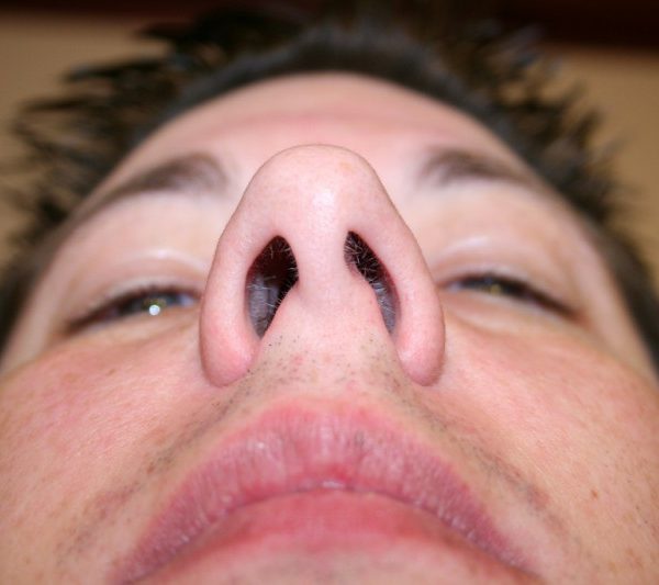 Cirugía de nariz Dr. Efraín López