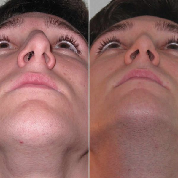 Dr. Efraín López Otorrinolaringólogo Quito Rinoplastia Quito