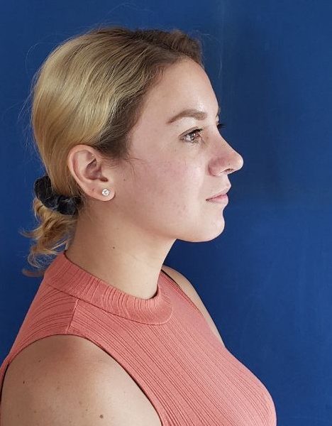 Caso 19 RInoplastia Quito Cirugia de Nariz Doctor Efrain López Caso 19 RInoplastia Quito Cirugia de Nariz Doctor Efrain López