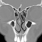 Cirugia desviación de tabique