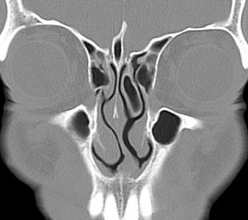 Cirugia desviación de tabique